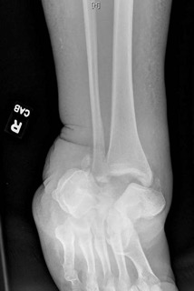 Key Pearls On Using Distal Tibial Distraction Osteogenesis For Limb